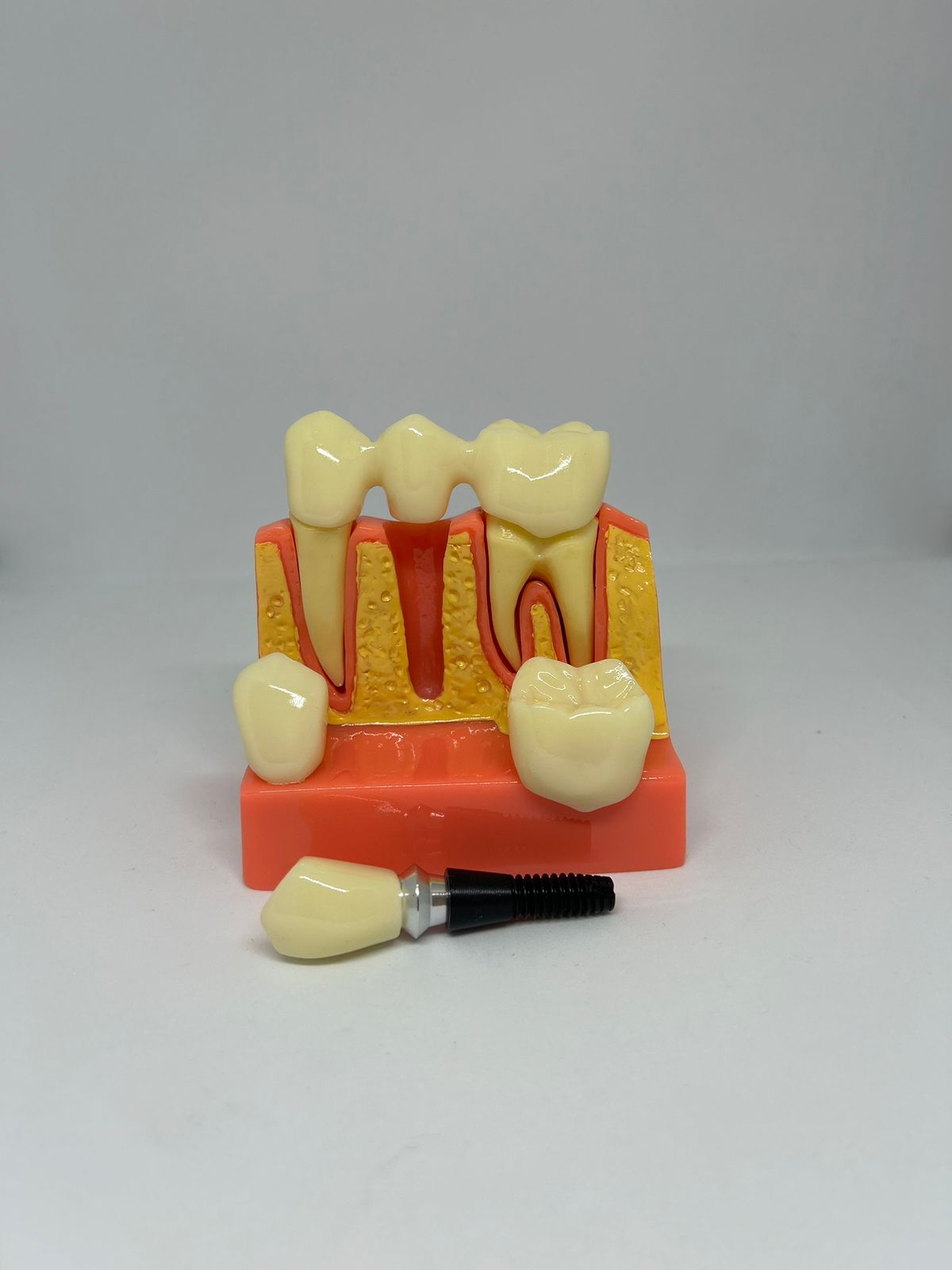Implant-bridge model