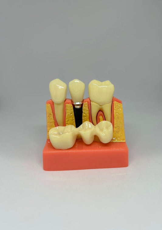 Implant-bridge model